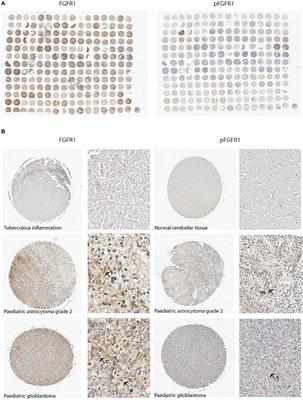 FGFR1 Expression and Role in Migration in Low and High Grade Pediatric Gliomas